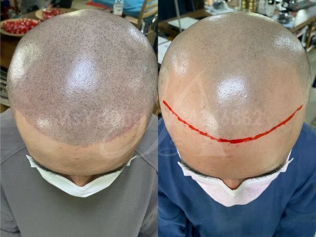  SMP (SCALP MICROPIGMENTATION )